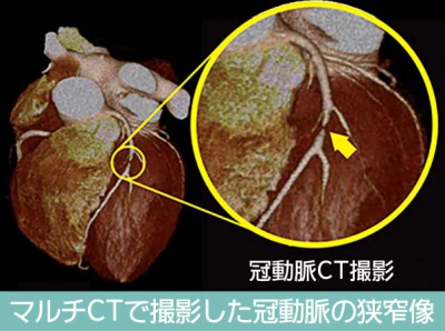 心肌梗塞如何检查最精确？冠状动脉造影 